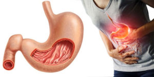 Виразка шлунка: симптоми та лікування
