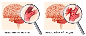 Що потрібно зробити, щоб не було інсульту?